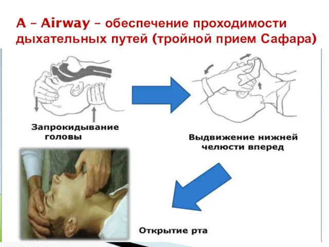 A – Airway – обеспечение проходимости дыхательных путей (тройной прием Сафара)