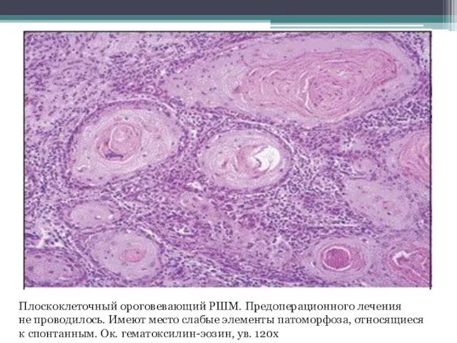 Плоскоклеточный ороговевающий РШМ. Предоперационного лечения не проводилось. Имеют место слабые элементы патоморфоза, относящиеся