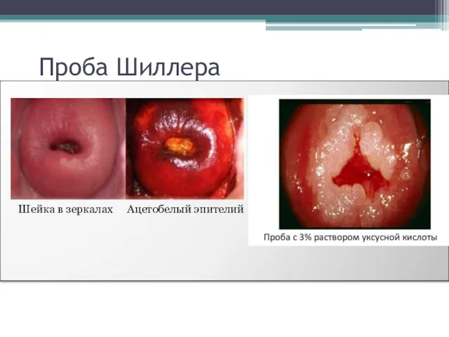 Проба Шиллера Шейка в зеркалах Ацетобелый эпителий