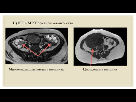 Б) КТ и МРТ органов малого таза Многочисленные кисты в яичниках Цистаденома яичника