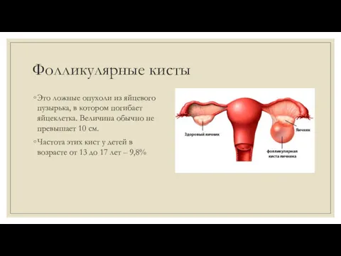 Фолликулярные кисты Это ложные опухоли из яйцевого пузырька, в котором