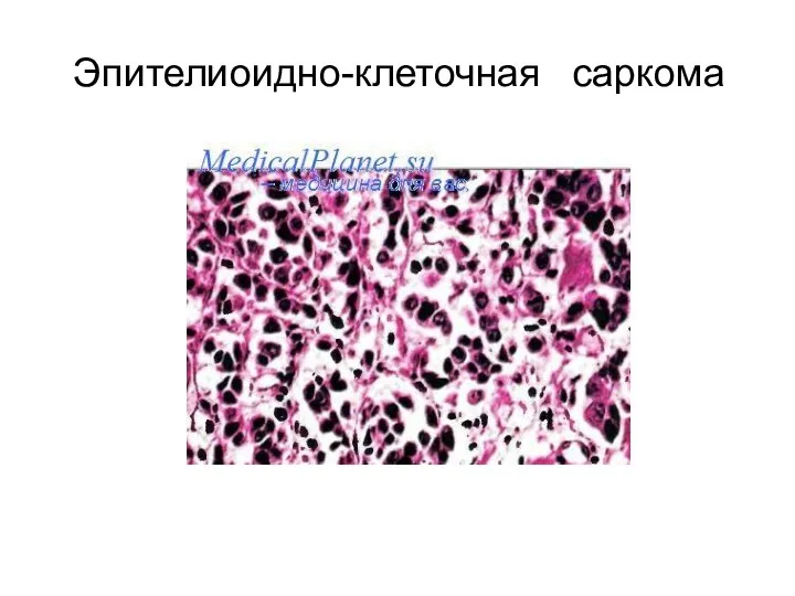 Эпителиоидно-клеточная саркома