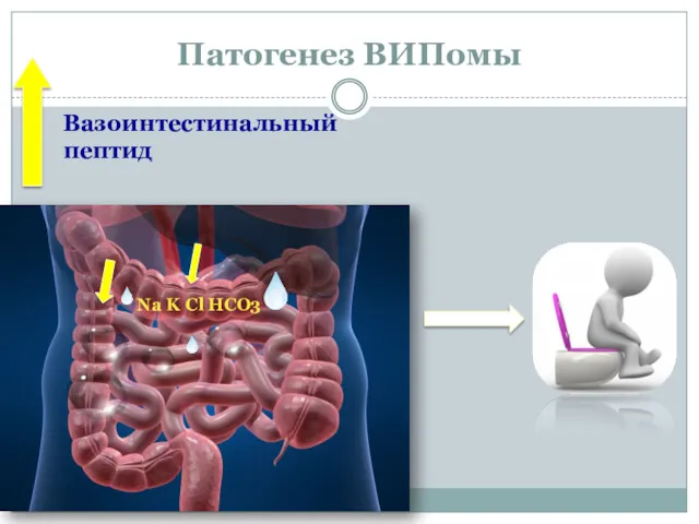 Патогенез ВИПомы Вазоинтестинальный пептид Na K Cl HCO3