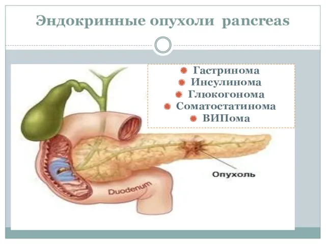 Эндокринные опухоли pancreas Гастринома Инсулинома Глюкогонома Соматостатинома ВИПома