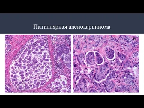 Папиллярная аденокарцинома