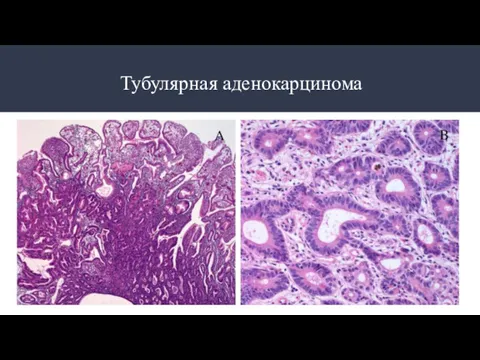 Тубулярная аденокарцинома