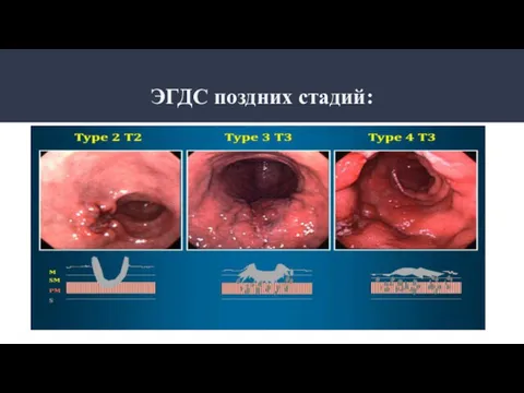 ЭГДС поздних стадий: