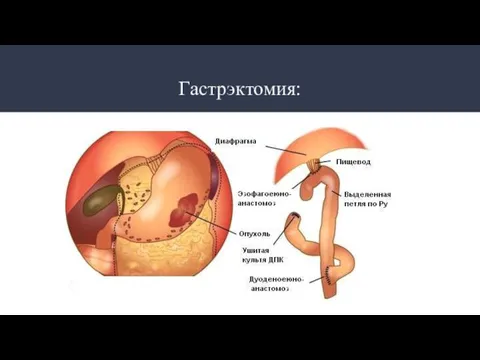 Гастрэктомия: