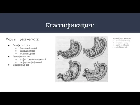 Классификация: Формы рака желудка: Экзофитный тип блюдцеобразный бляшковидный полиповидный Эндофитный