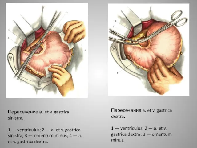 Пересечение а. et v. gastrica sinistra. 1 — ventriсulus; 2