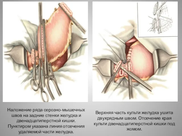 Наложение ряда серозно-мышечных швов на задние стенки желудка и двенадцатиперстной