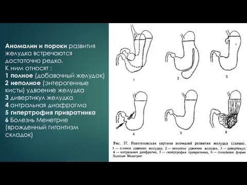 Аномалии и пороки развития желудка встречаются достаточно редко. К ним