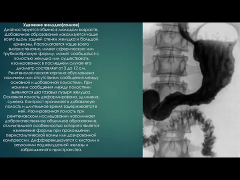 Удвоение желудка(полное) Диагностируется обычно в молодом возрасте. Добавочное образование локализуется