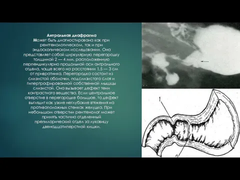 Антральная диафрагма Может быть диагностирована как при рентгенологическом, так и