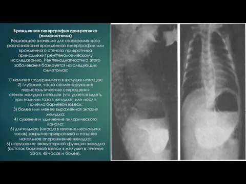 Врожденная гипертрофия привратника(пилоростеноз) Решающее значение для своевременного распознавания врожденной гипертрофии