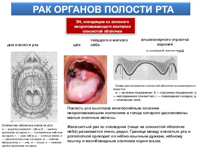 РАК ОРГАНОВ ПОЛОСТИ РТА ЗН, исходящие из плоского неороговевающего эпителия