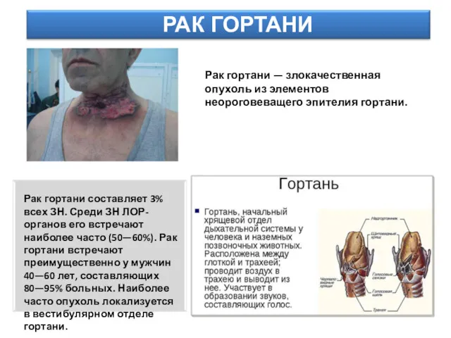 РАК ГОРТАНИ Рак гортани — злокачественная опухоль из элементов неороговеващего