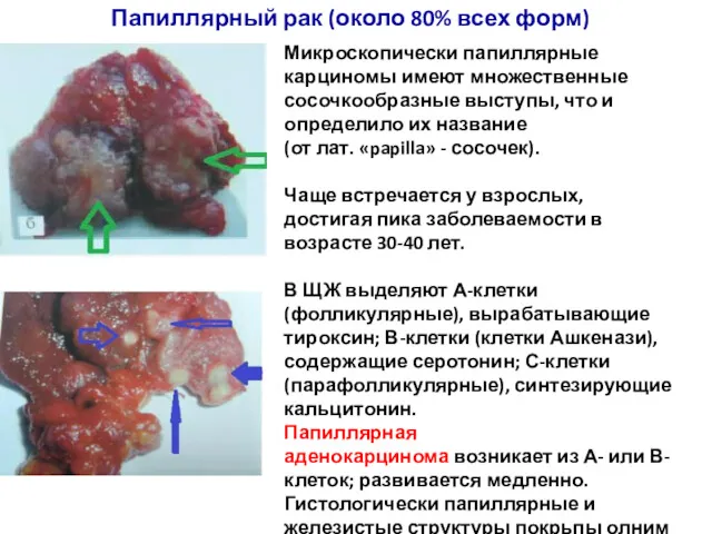 Папиллярный рак (около 80% всех форм) Микроскопически папиллярные карциномы имеют