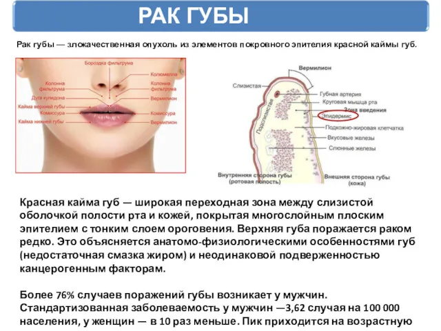 РАК ГУБЫ Рак губы — злокачественная опухоль из элементов покровного