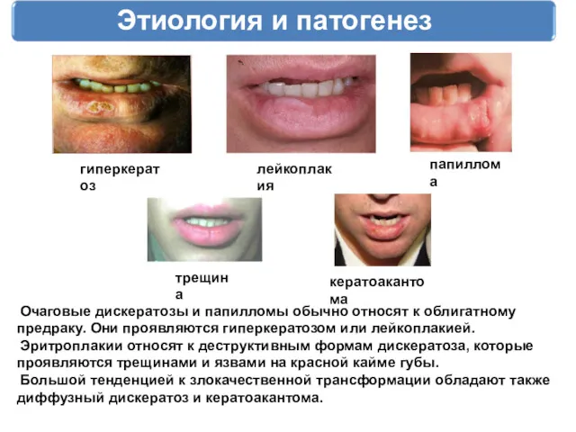 Этиология и патогенез гиперкератоз лейкоплакия папиллома трещина кератоакантома Очаговые дискератозы