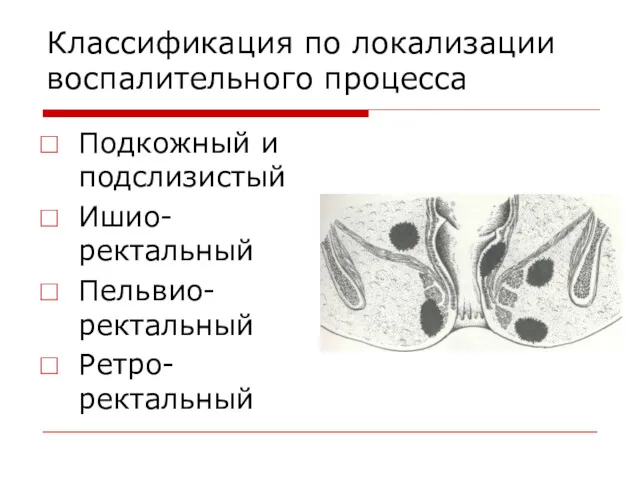 Классификация по локализации воспалительного процесса Подкожный и подслизистый Ишио-ректальный Пельвио-ректальный Ретро-ректальный