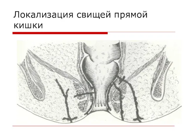 Локализация свищей прямой кишки