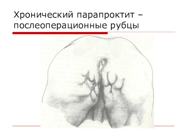 Хронический парапроктит – послеоперационные рубцы