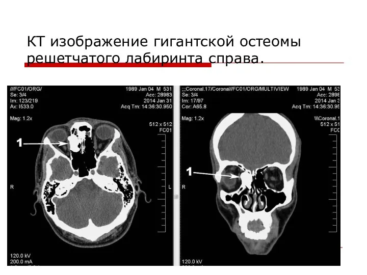 КТ изображение гигантской остеомы решетчатого лабиринта справа.