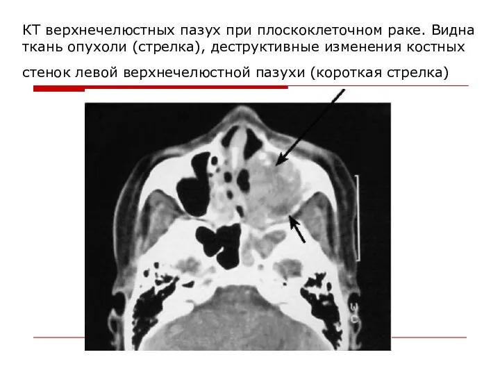 КТ верхнечелюстных пазух при плоскоклеточном раке. Видна ткань опухоли (стрелка),