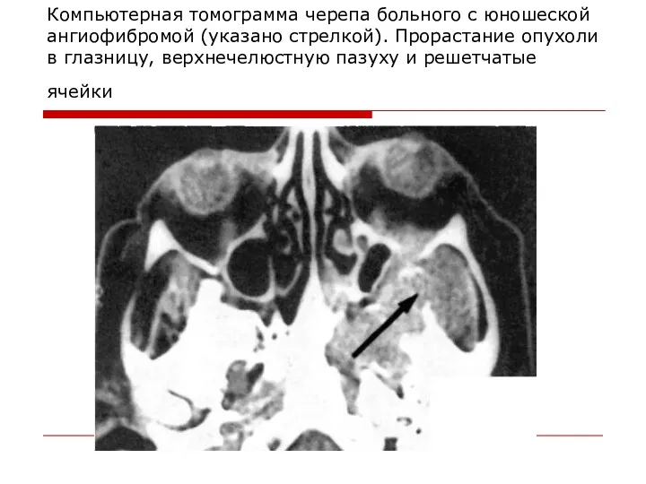 Компьютерная томограмма черепа больного с юношеской ангиофибромой (указано стрелкой). Прорастание