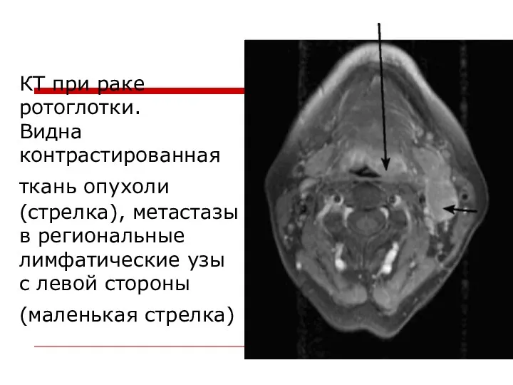 КТ при раке ротоглотки. Видна контрастированная ткань опухоли (стрелка), метастазы