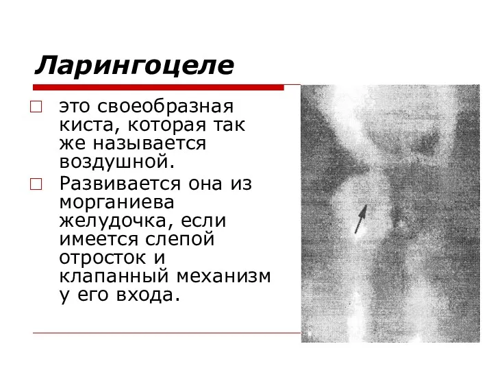 Ларингоцеле это своеобразная киста, которая так же называется воздушной. Развивается