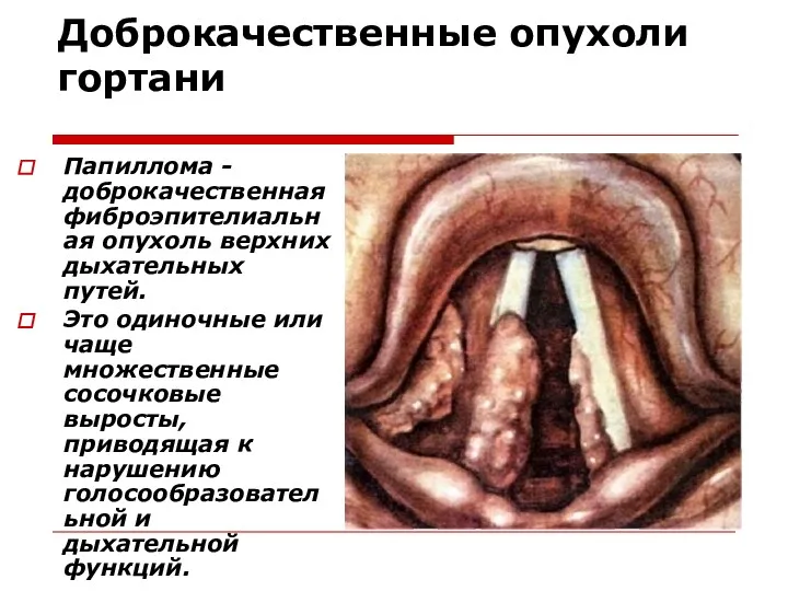 Доброкачественные опухоли гортани Папиллома - доброкачественная фиброэпителиальная опухоль верхних дыхательных