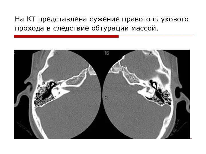 На КТ представлена сужение правого слухового прохода в следствие обтурации массой.