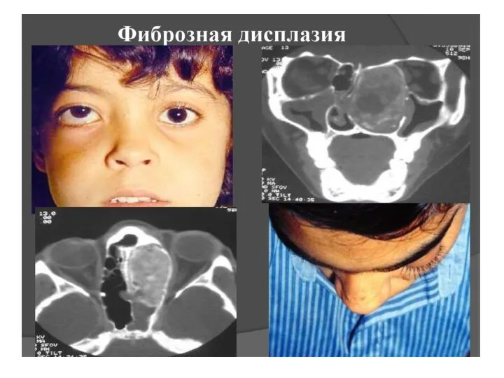 Фиброзная дисплазия