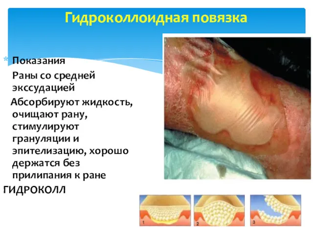 Гидроколлоидная повязка Показания Раны со средней экссудацией Абсорбируют жидкость, очищают рану, стимулируют грануляции