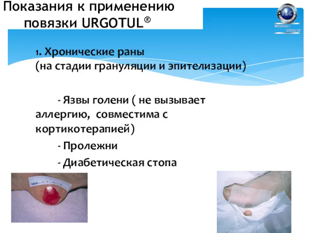 1. Хронические раны (на стадии грануляции и эпителизации) - Язвы голени ( не