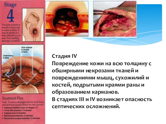 Стадия IV Повреждение кожи на всю толщину с обширными некрозами тканей и повреждениями