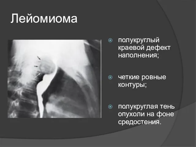 Лейомиома полукруглый краевой дефект наполнения; четкие ровные контуры; полукруглая тень опухоли на фоне средостения.