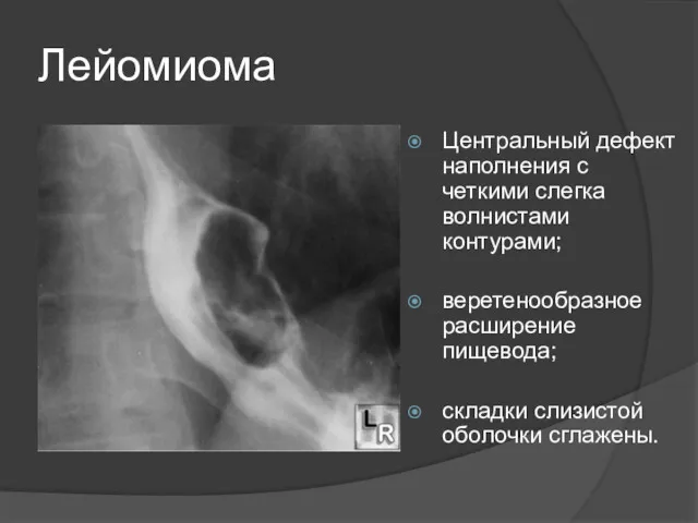 Лейомиома Центральный дефект наполнения с четкими слегка волнистами контурами; веретенообразное расширение пищевода; складки слизистой оболочки сглажены.