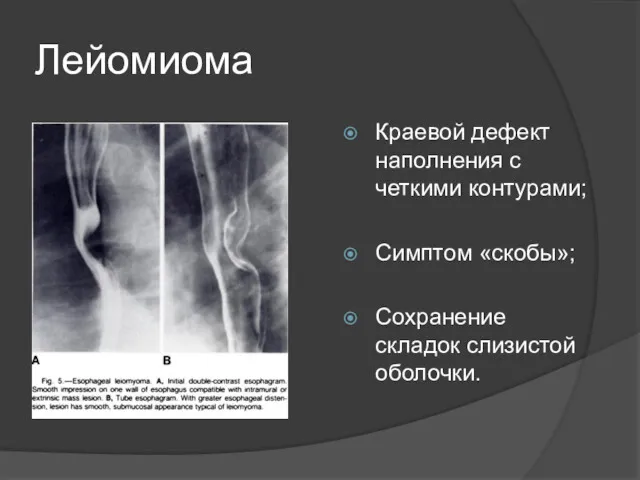 Лейомиома Краевой дефект наполнения с четкими контурами; Симптом «скобы»; Сохранение складок слизистой оболочки.