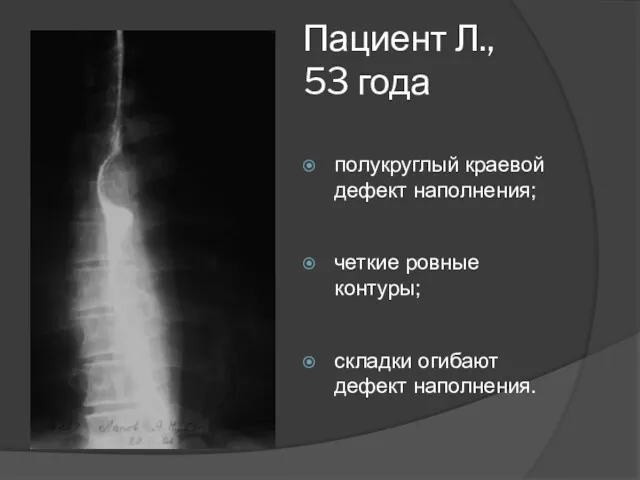 Пациент Л., 53 года полукруглый краевой дефект наполнения; четкие ровные контуры; складки огибают дефект наполнения.