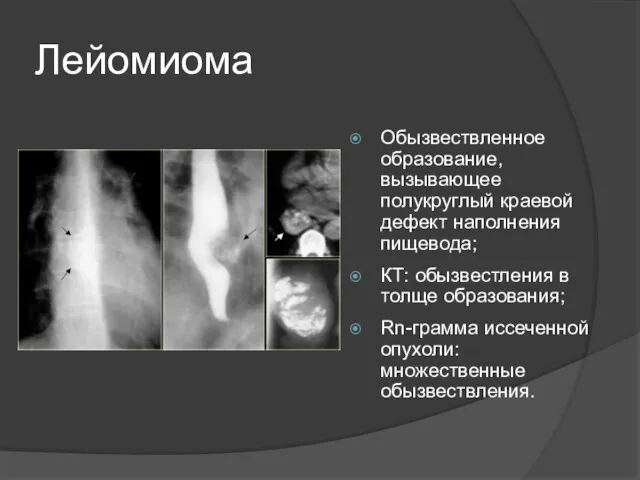 Лейомиома Обызвествленное образование, вызывающее полукруглый краевой дефект наполнения пищевода; КТ: