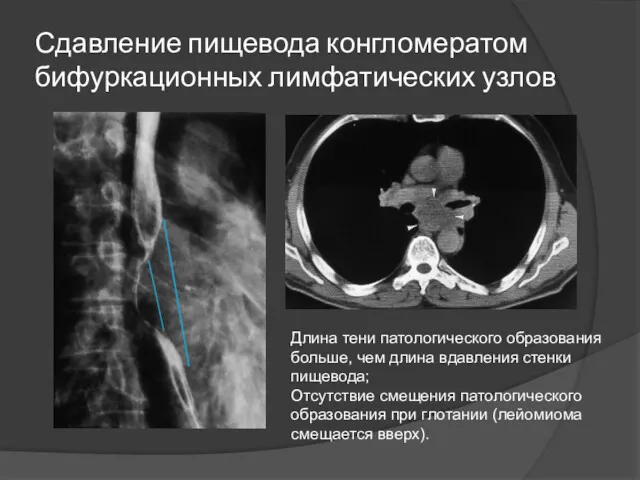 Сдавление пищевода конгломератом бифуркационных лимфатических узлов Длина тени патологического образования