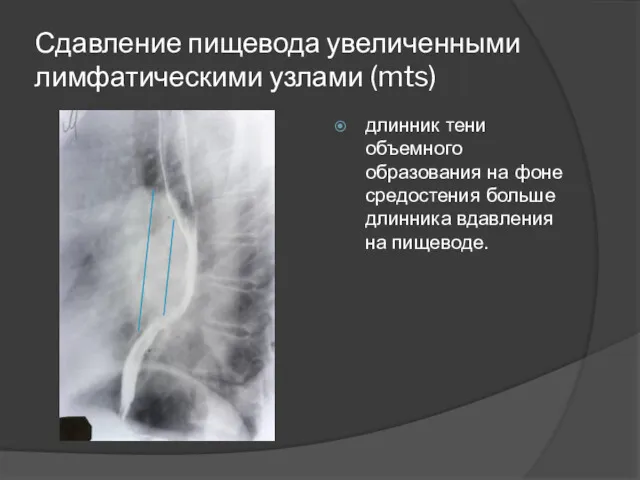 Сдавление пищевода увеличенными лимфатическими узлами (mts) длинник тени объемного образования