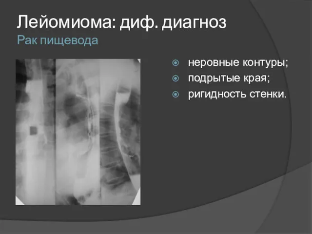 Лейомиома: диф. диагноз Рак пищевода неровные контуры; подрытые края; ригидность стенки.