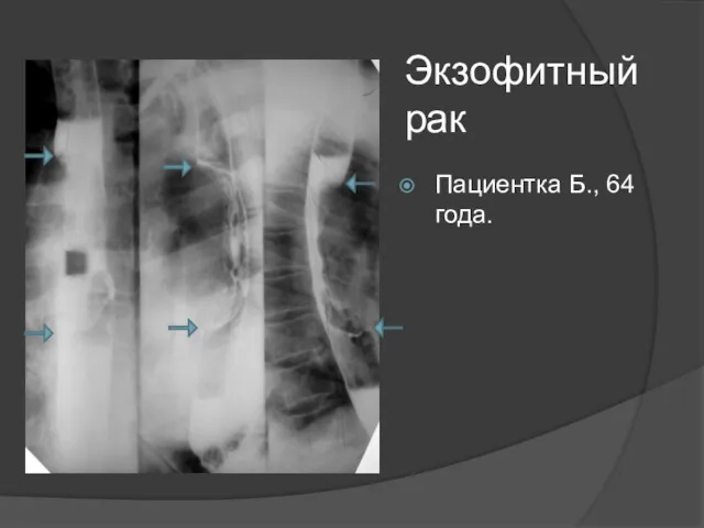 Экзофитный рак Пациентка Б., 64 года.