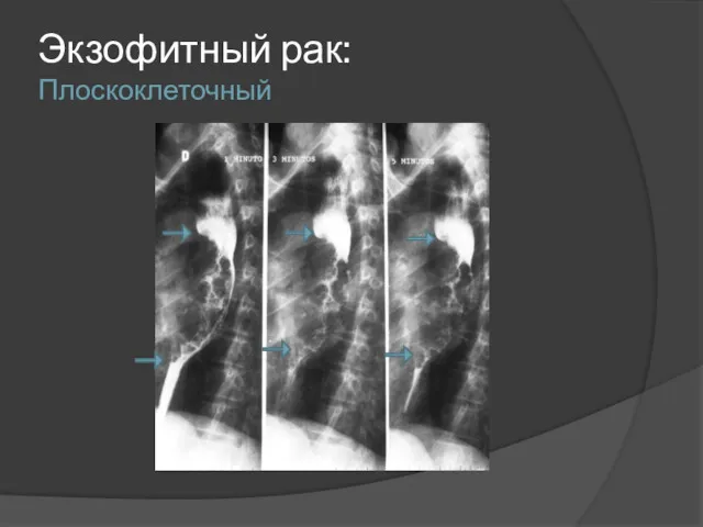 Экзофитный рак: Плоскоклеточный