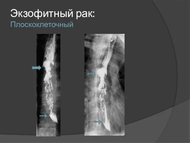 Экзофитный рак: Плоскоклеточный