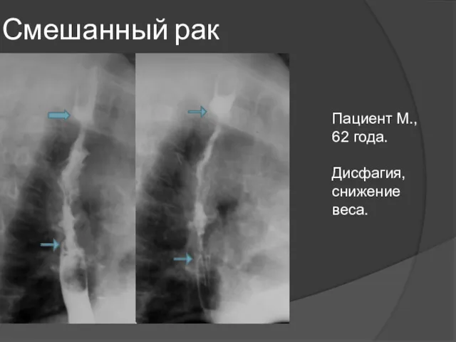 Смешанный рак Пациент М., 62 года. Дисфагия, снижение веса.